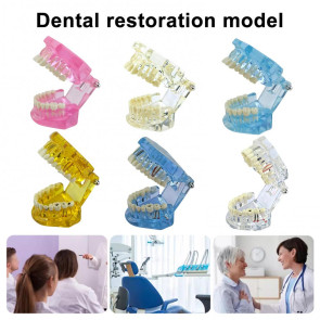 Dental Implant Model Teaching Aid for Dentist Student School Removable Teeth Orthodontic Demo Models Dental Prosthetic Demonstration