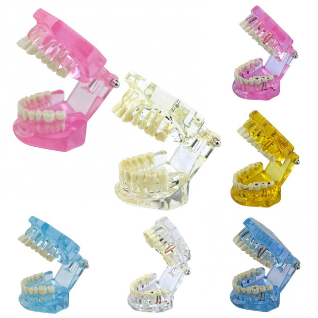 Dental Implant Model Teaching Aid for Dentist Student School Removable Teeth Orthodontic Demo Models Dental Prosthetic Demonstration