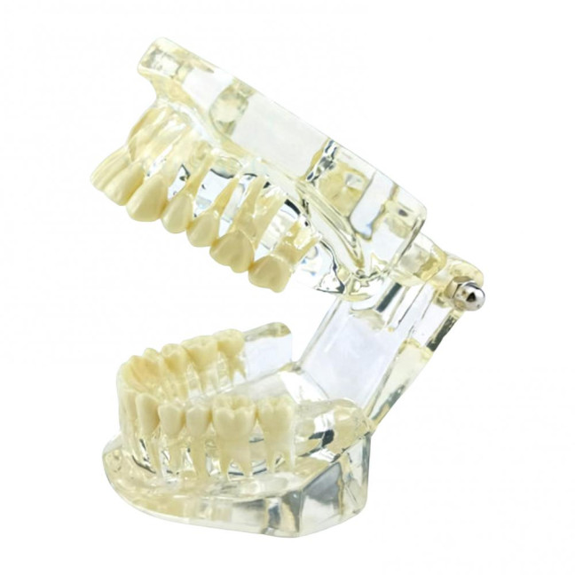Dental Implant Model Teaching Aid for Dentist Student School Removable Teeth Orthodontic Demo Models Dental Prosthetic Demonstration