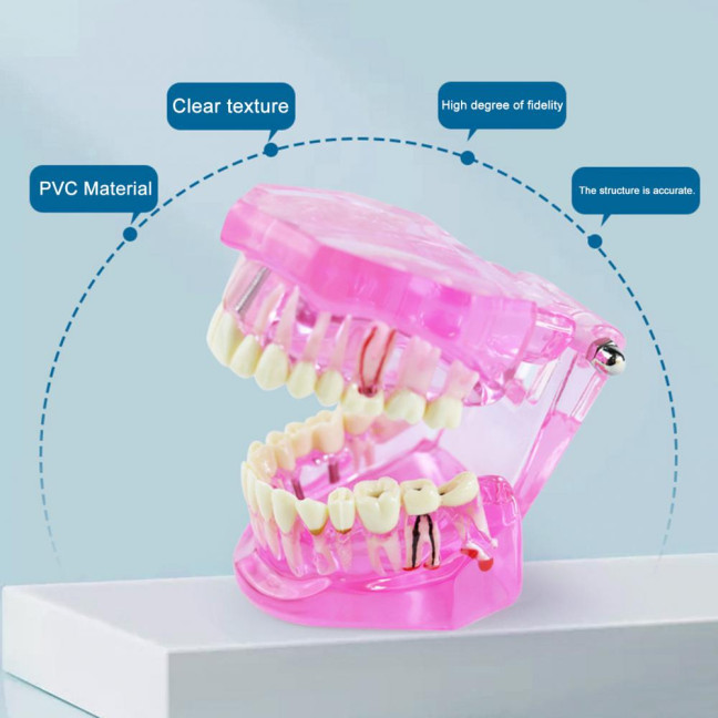 Dental Implant Model Teaching Aid for Dentist Student School Removable Teeth Orthodontic Demo Models Dental Prosthetic Demonstration