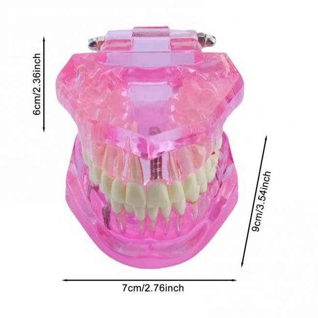 Dental Implant Model Teaching Aid for Dentist Student School Removable Teeth Orthodontic Demo Models Dental Prosthetic Demonstration