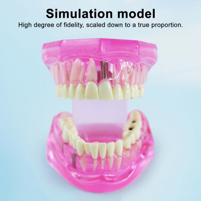 Dental Implant Model Teaching Aid for Dentist Student School Removable Teeth Orthodontic Demo Models Dental Prosthetic Demonstration