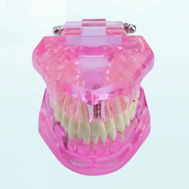 Dental Implant Model Teaching Aid for Dentist Student School Removable Teeth Orthodontic Demo Models Dental Prosthetic Demonstration