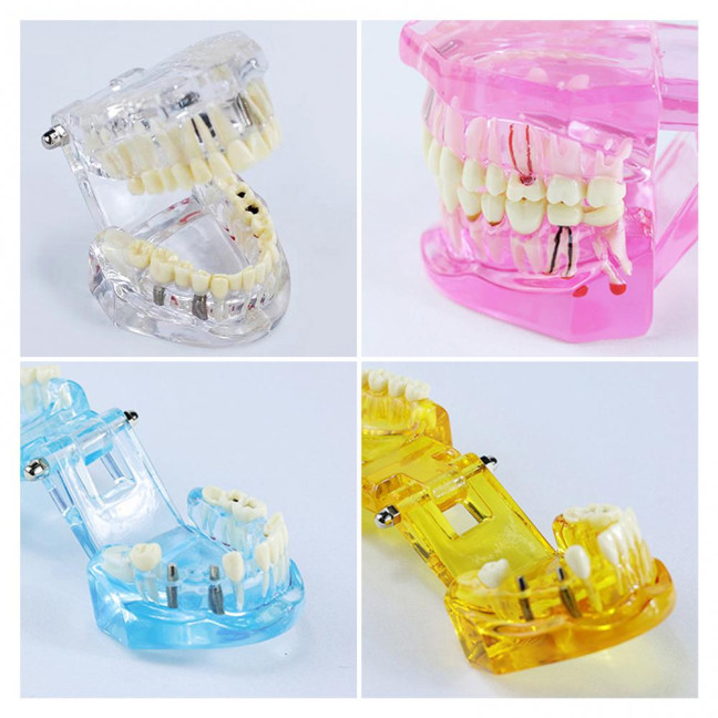 Dental Implant Model Teaching Aid for Dentist Student School Removable Teeth Orthodontic Demo Models Dental Prosthetic Demonstration