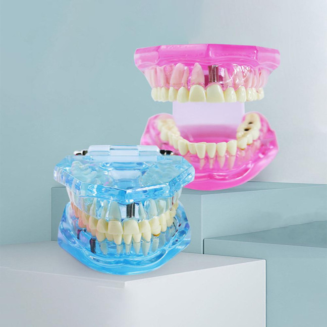 Dental Implant Model Teaching Aid for Dentist Student School Removable Teeth Orthodontic Demo Models Dental Prosthetic Demonstration